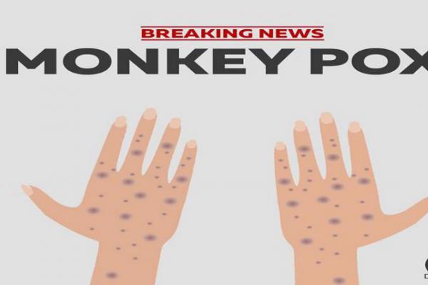 Kemenkes: Kasus Monkeypox Belum Ditemukan di Indonesia