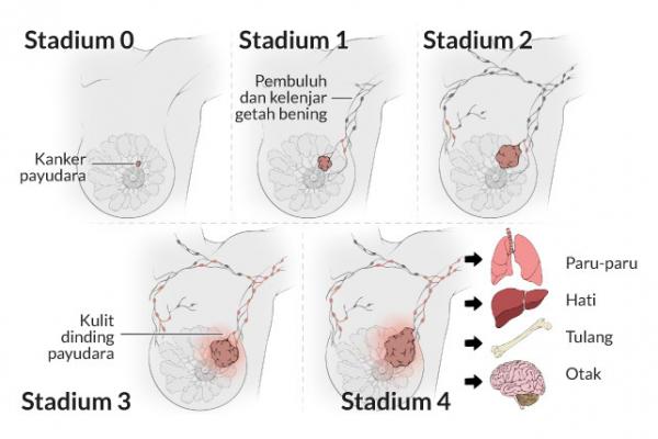 Cegah Kanker Payudara, Pemerintah Ajak Masyarakat Hidup Sehat